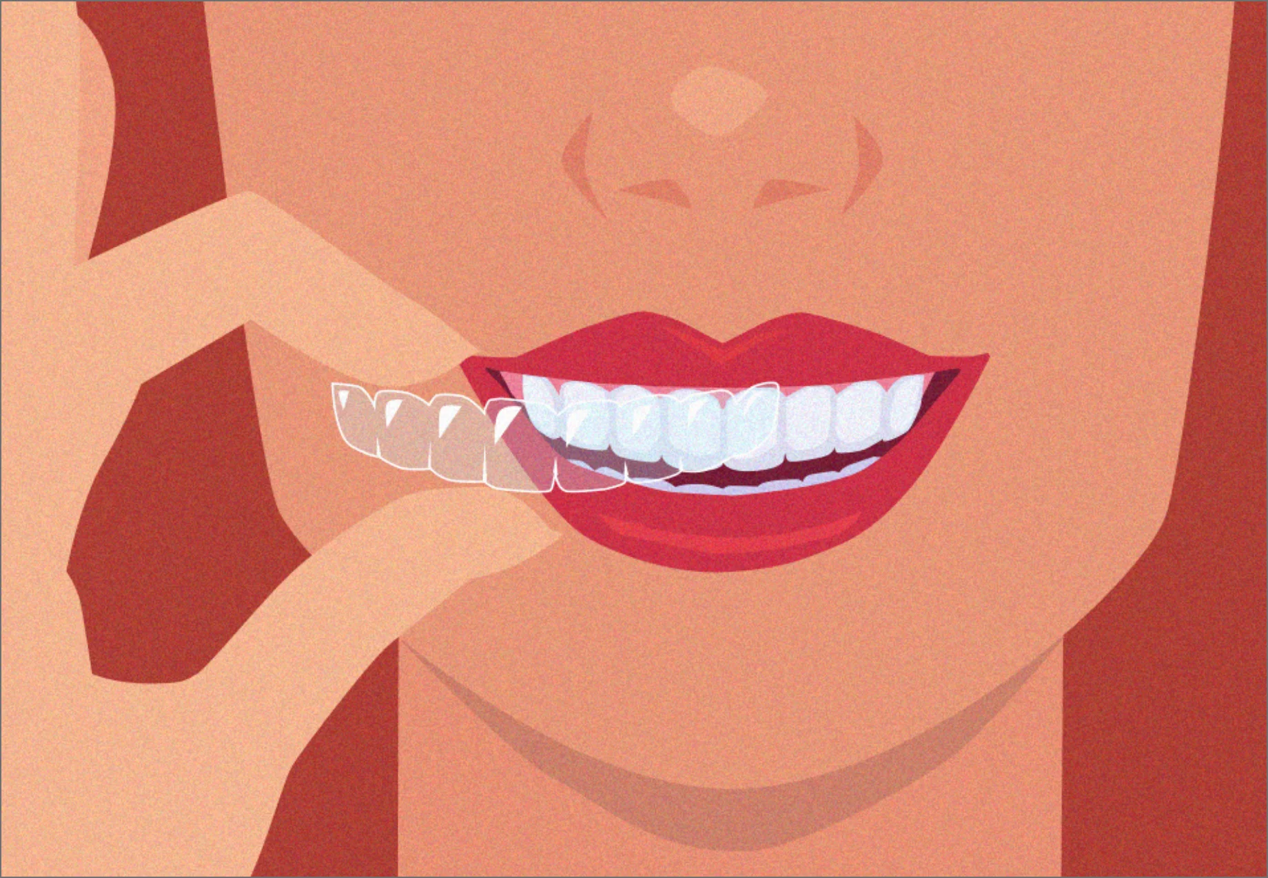 Woman putting on clear aligners
