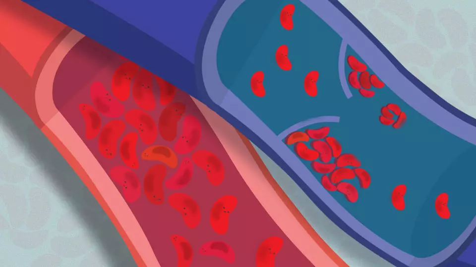  If You <3 Your Heart, Talk to Your Dentist About Thrombosis and Periodontal Disease 