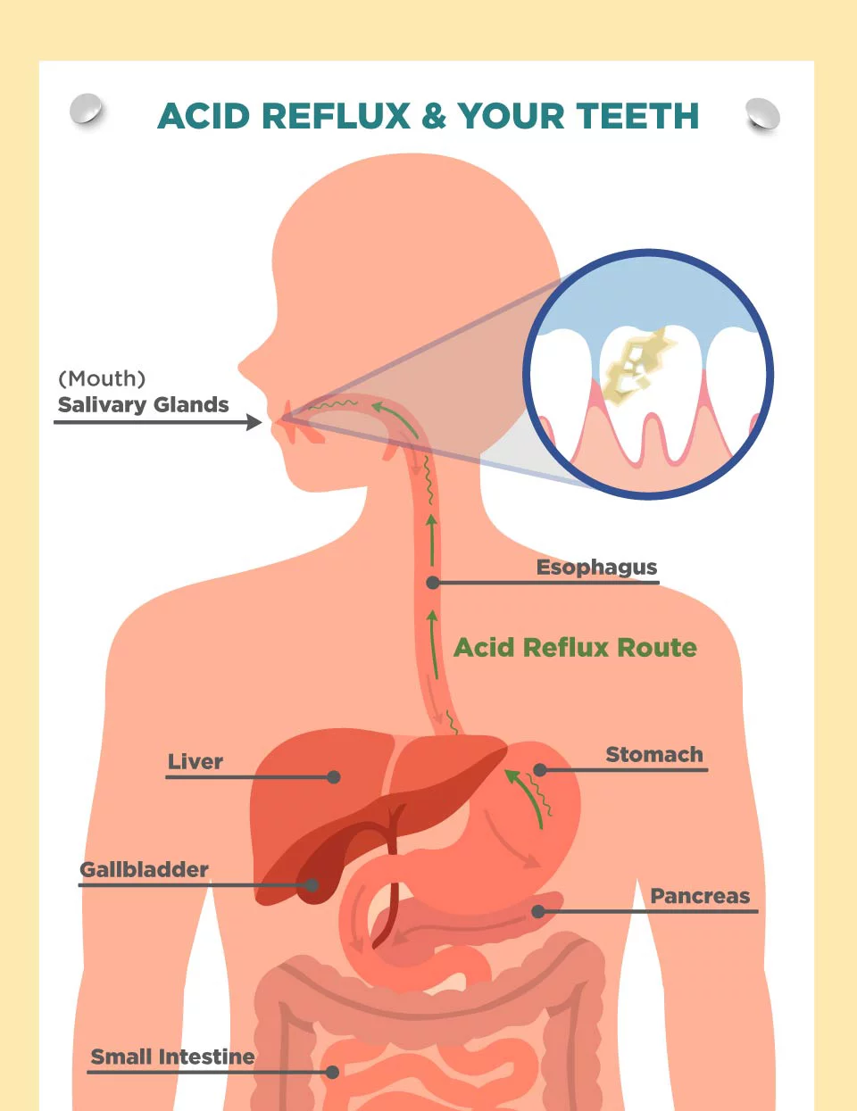 diagram of internal organs and acid reflux