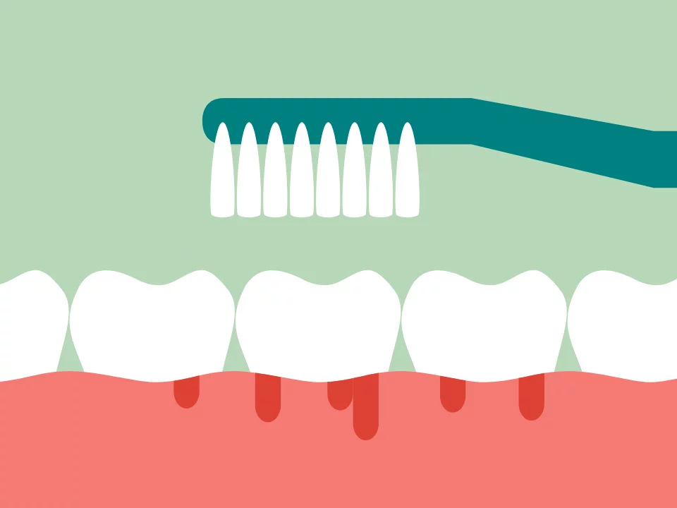 The Link Between Diabetes and Your Gums
