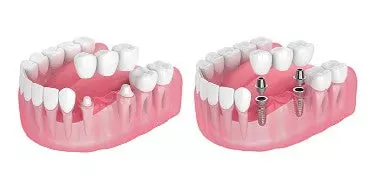 Denture supported bridge