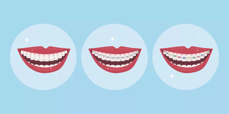 Types of Braces: Clear vs. Metal & More
