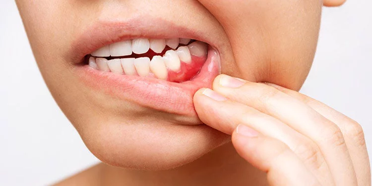 Person pulling their lips to show inflamed gums