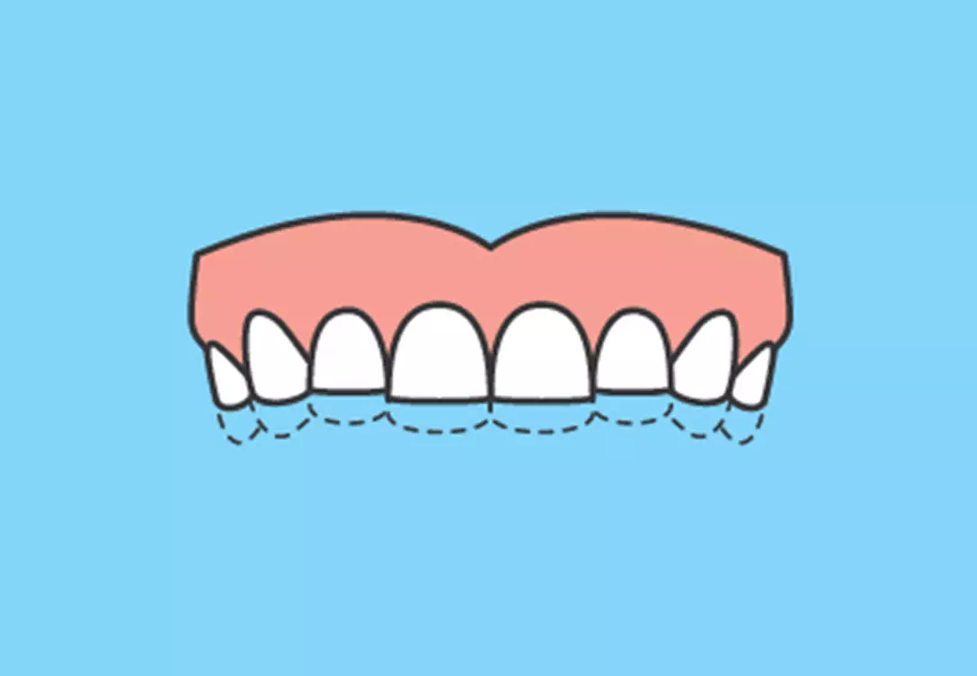 Bruxism (Teeth Grinding): Causes & Treatment