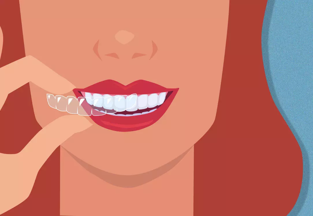 Ceramic Braces  Braces & Invisalign in Orange County