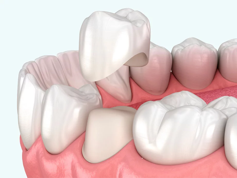 a dental crown being placed on a tooth
