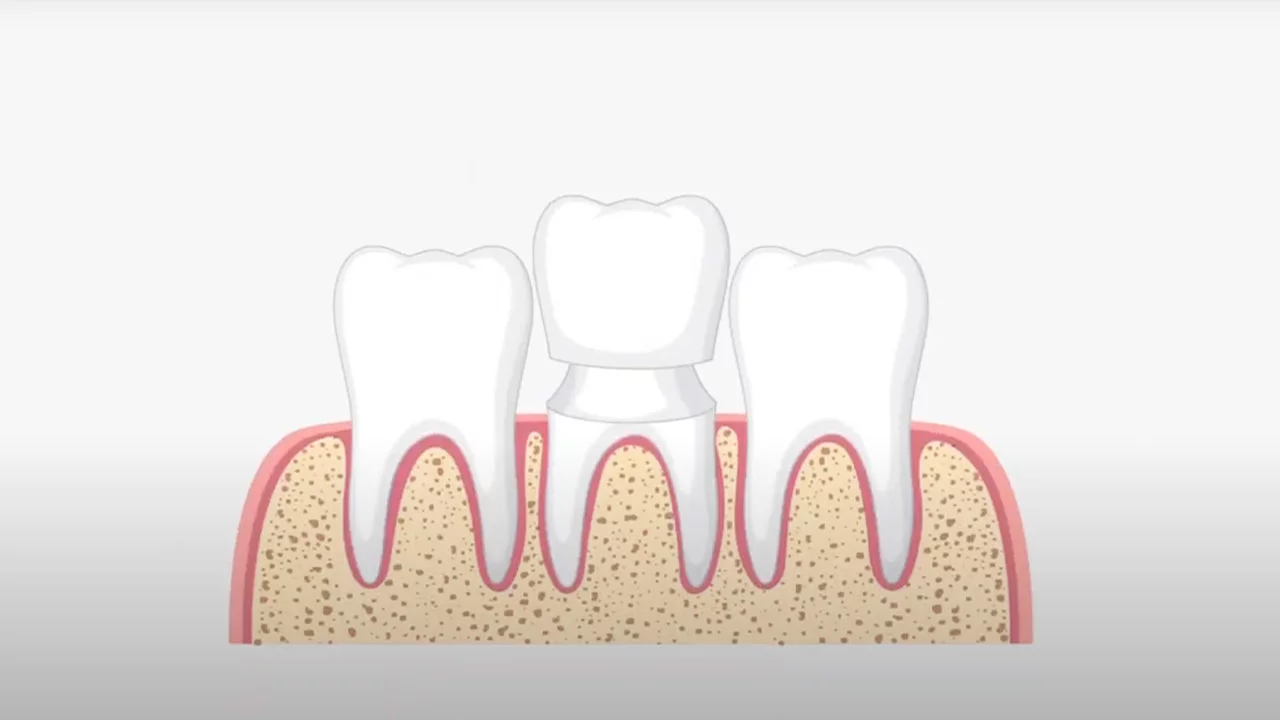 Dental Crowns