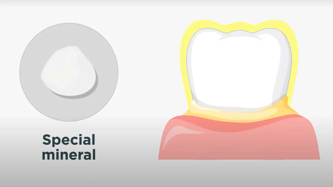 What is Fluoride Treatment?