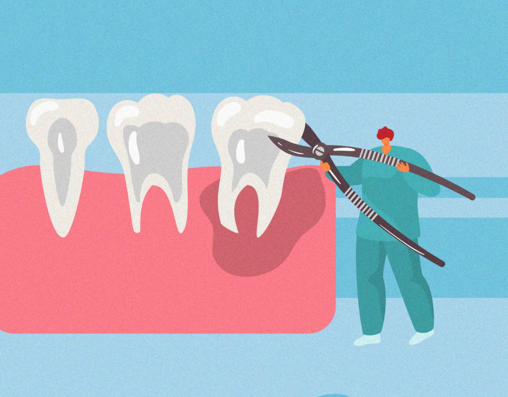 Dentist removing a tooth from gums