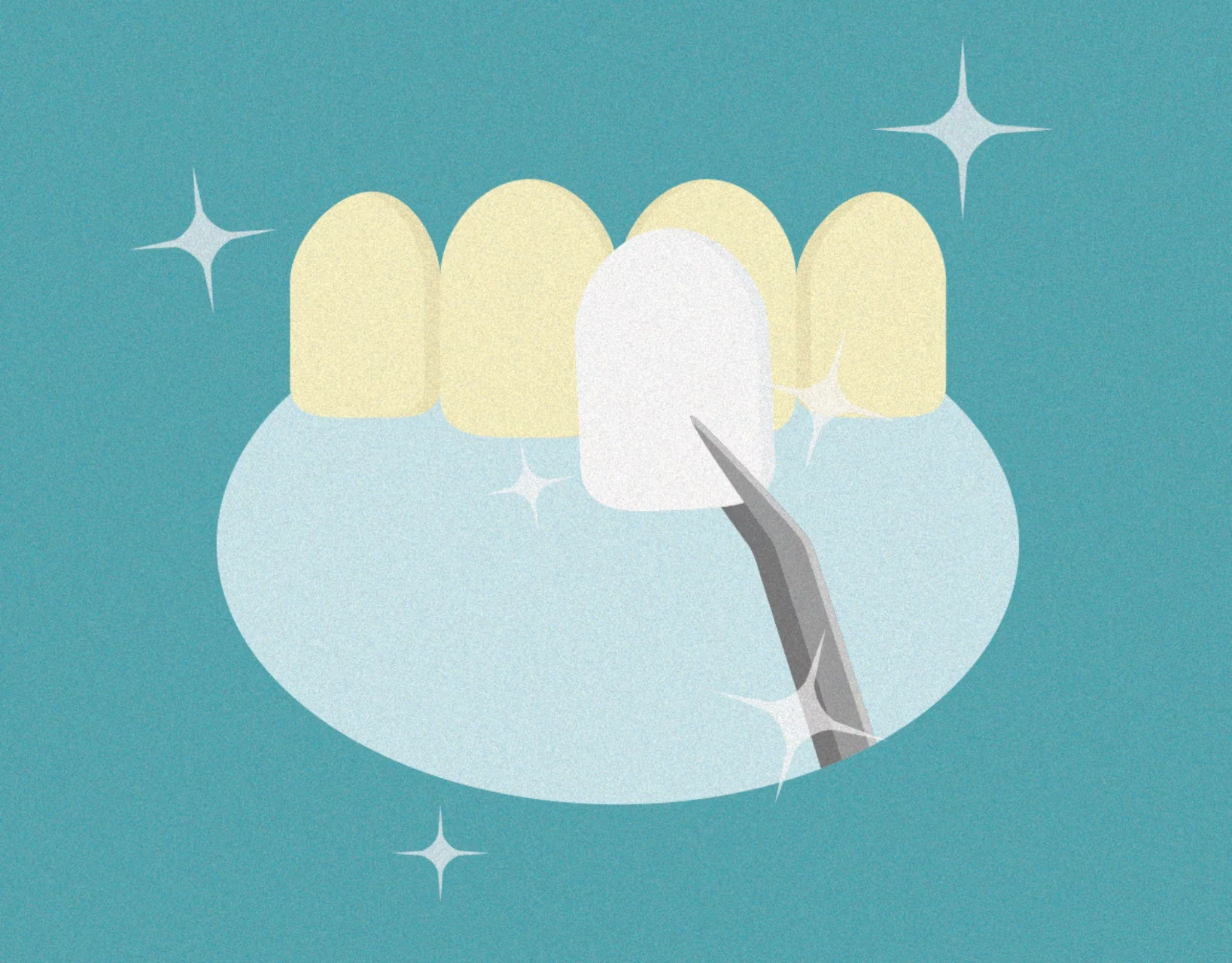 Tooth applying veneers