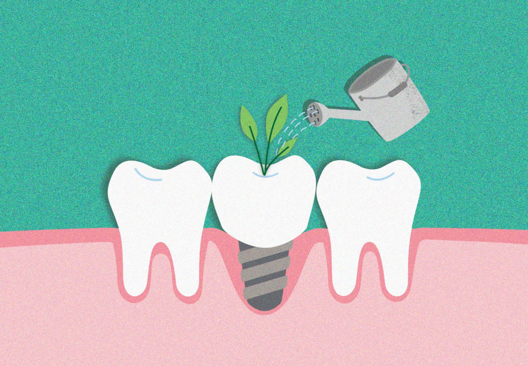 Teeth and implant getting watered 