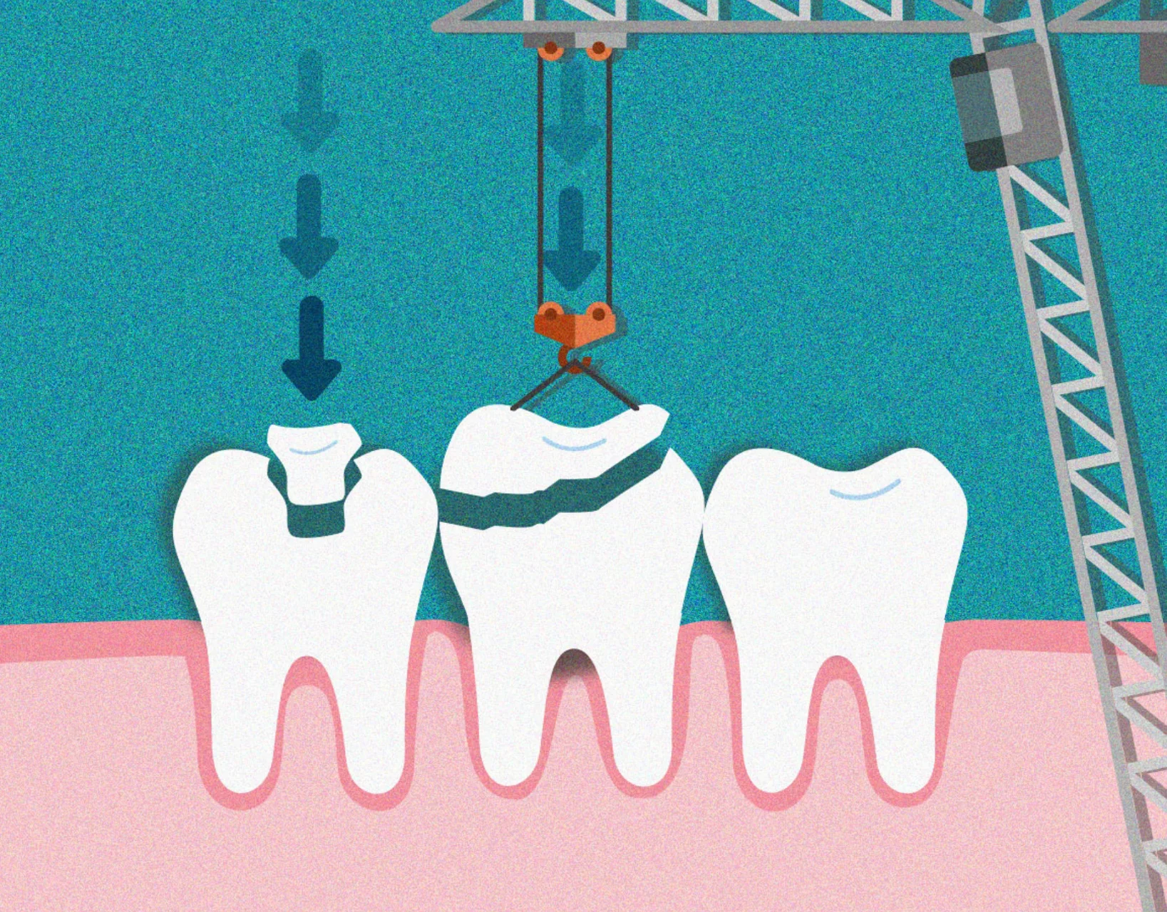 Three broken teeth with construction crane