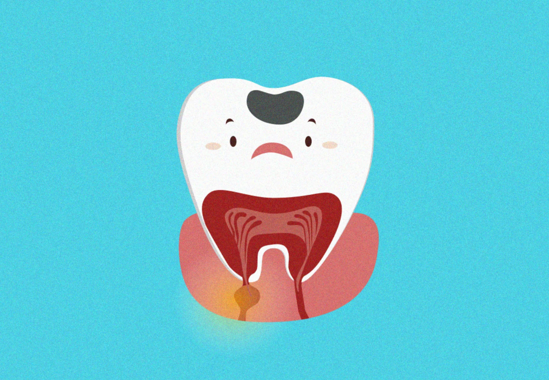 Tooth needing root canal