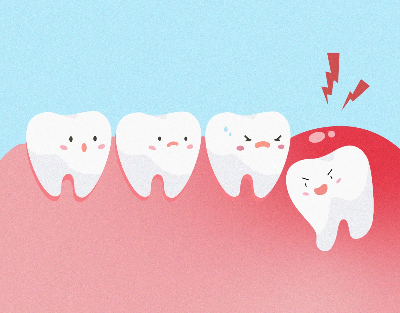 Wisdom Tooth Emerging Under Red Gums
