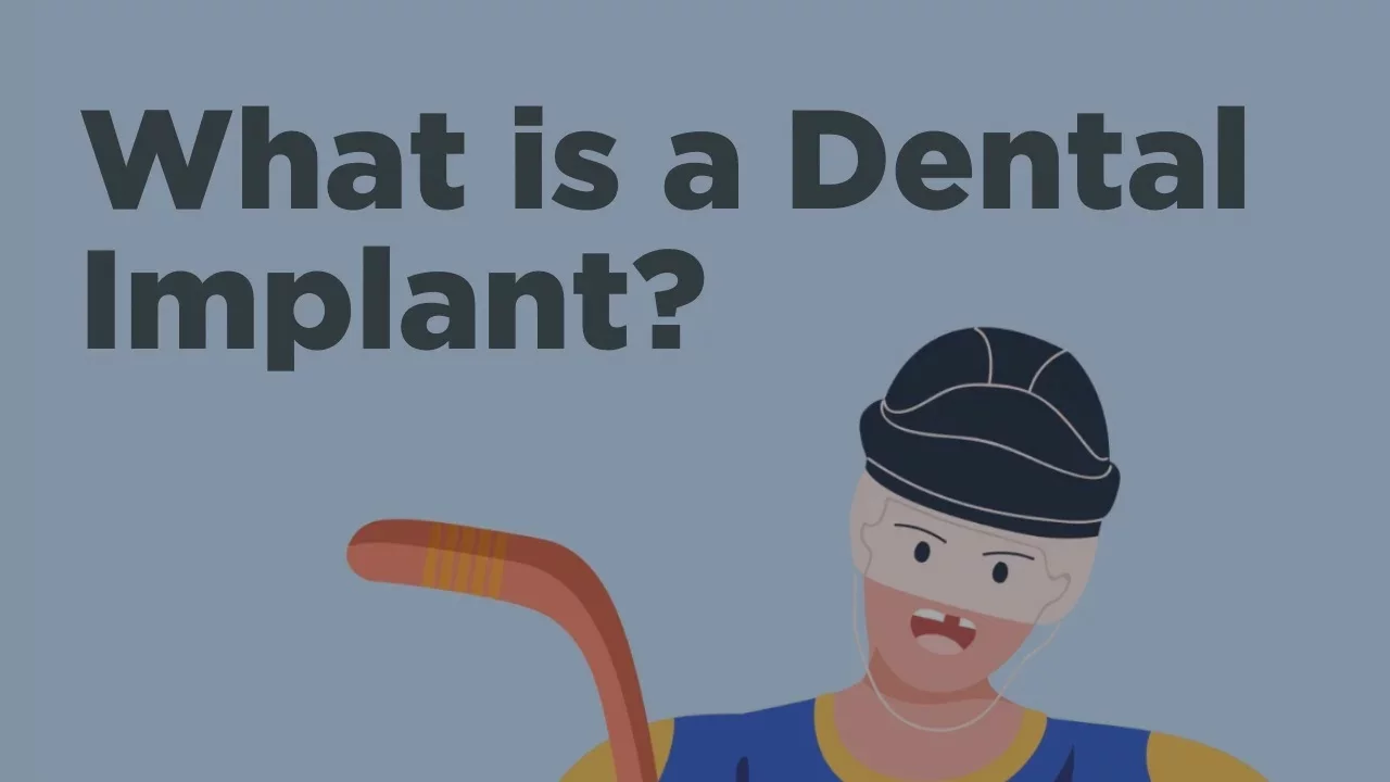 Dental Implants - Everything You Need to Know