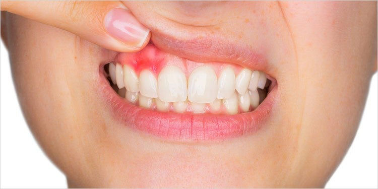 Infected mouth outlet ulcer