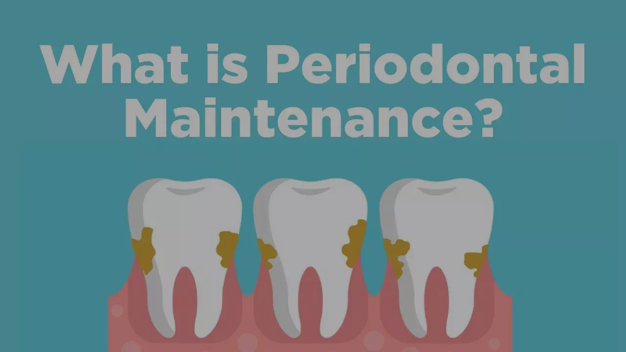 Periodontal Maintenance - What is it?