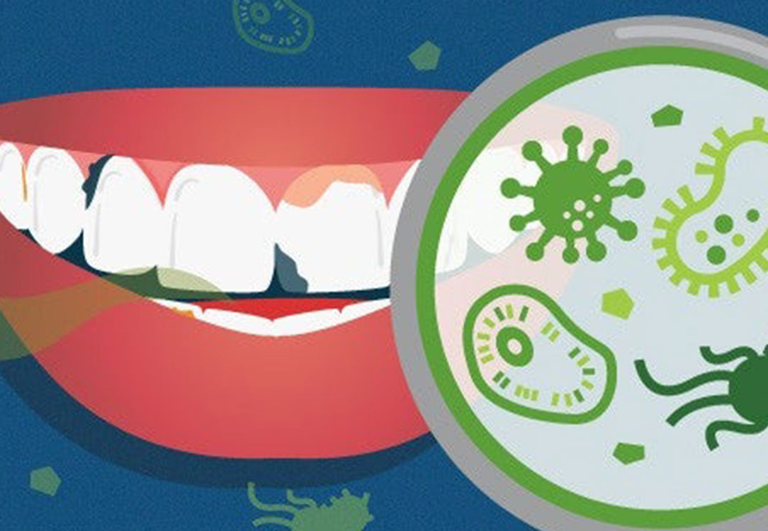  Poor Oral Health And Its Connection To Strokes 