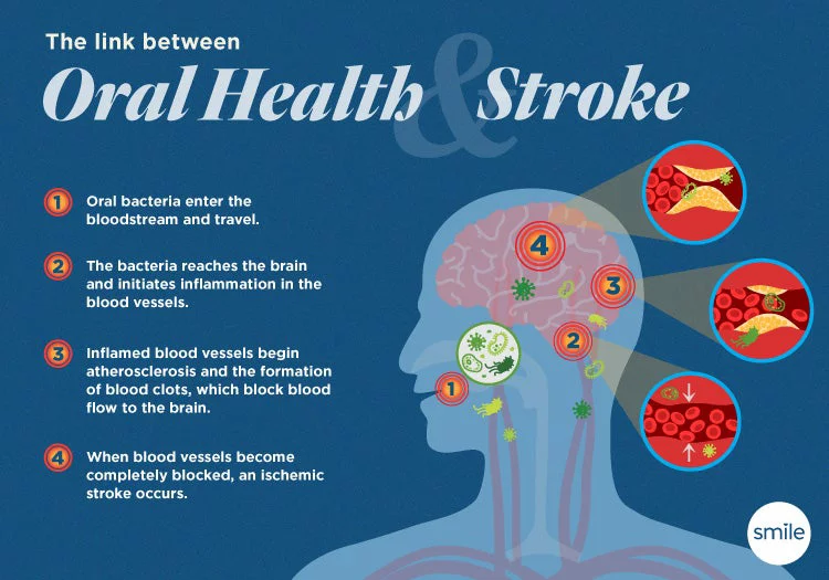 The process of how oral bacteria can affect ones health and cause a stroke