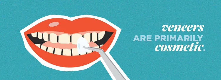 Mouth with veneers being placed. Veneers are primarily cosmetic