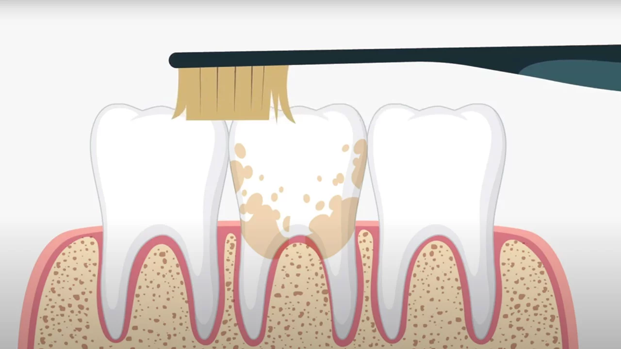 Everything You Need to Know About Teeth Cleaning