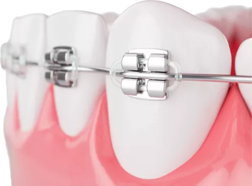 close up graphic of teeth with metal braces
