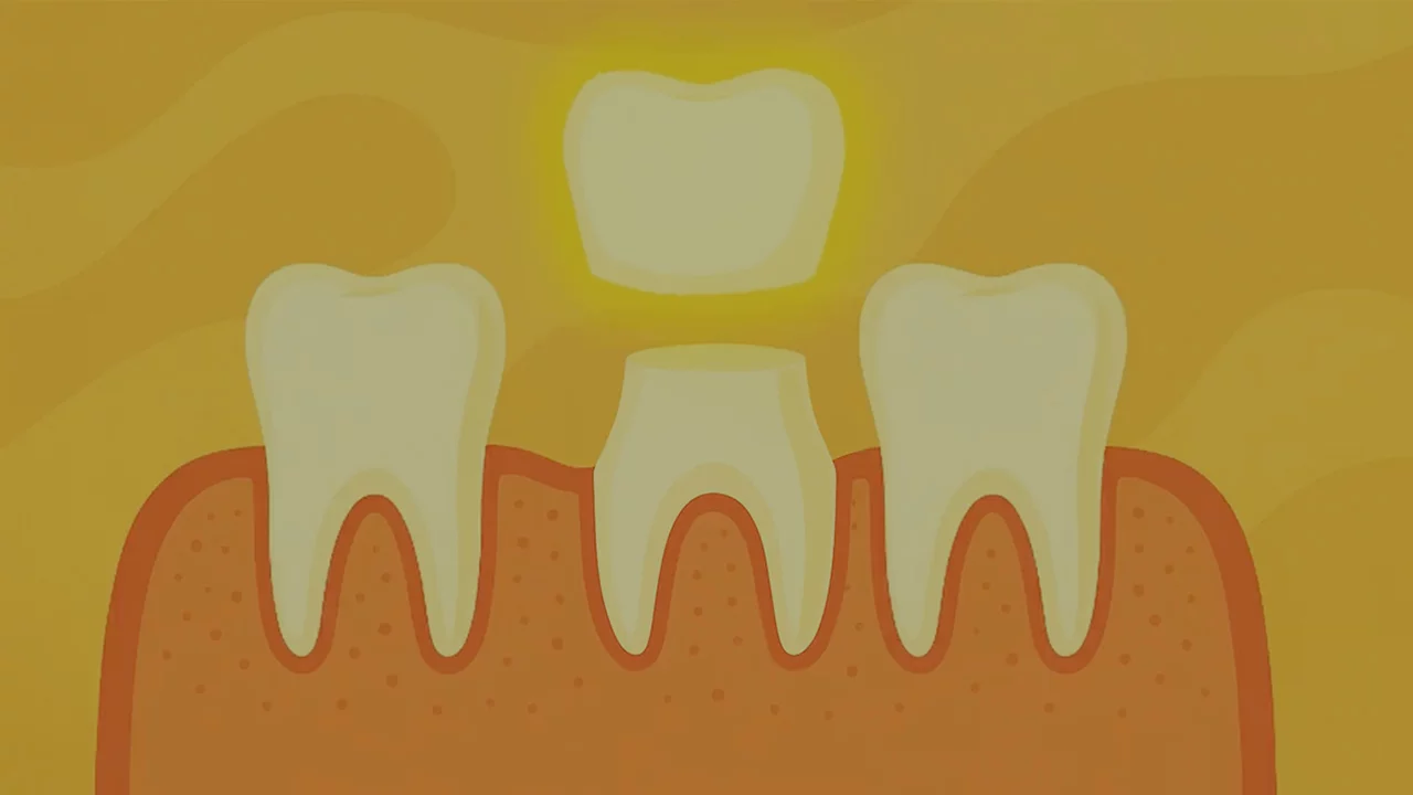 Understanding Dental Crowns