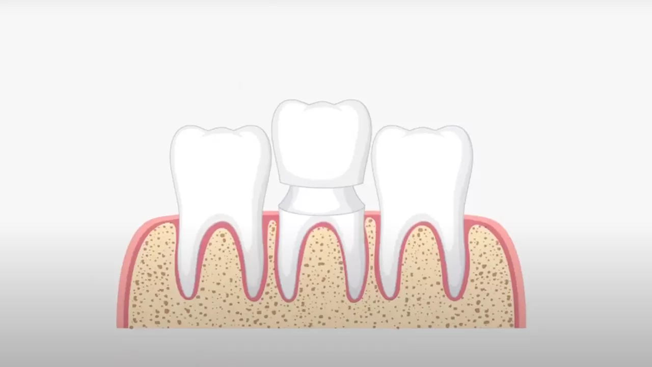Dental Crowns