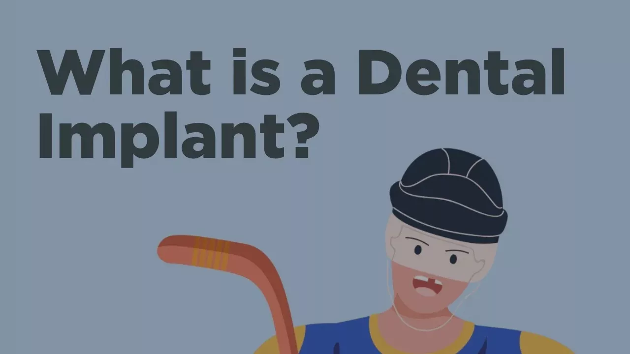 Dental Implants - Everything You Need to Know