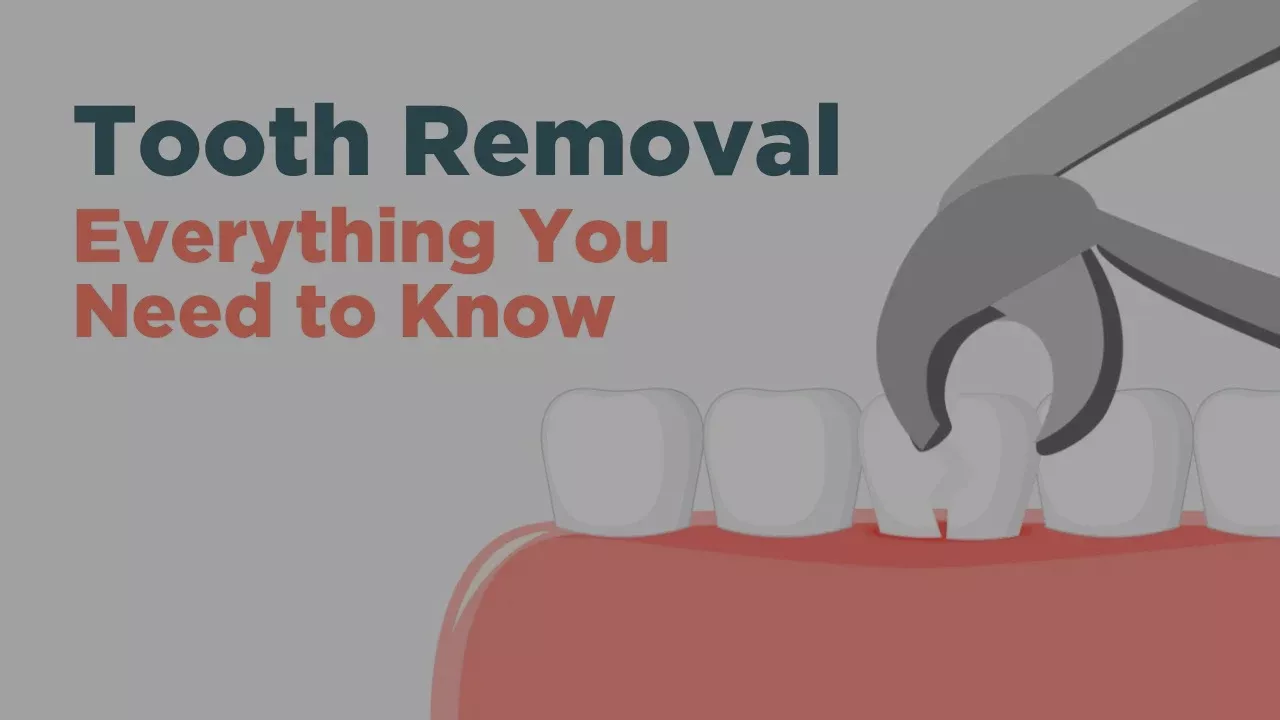 Surgically Removing a Tooth - Everything You Need to Know