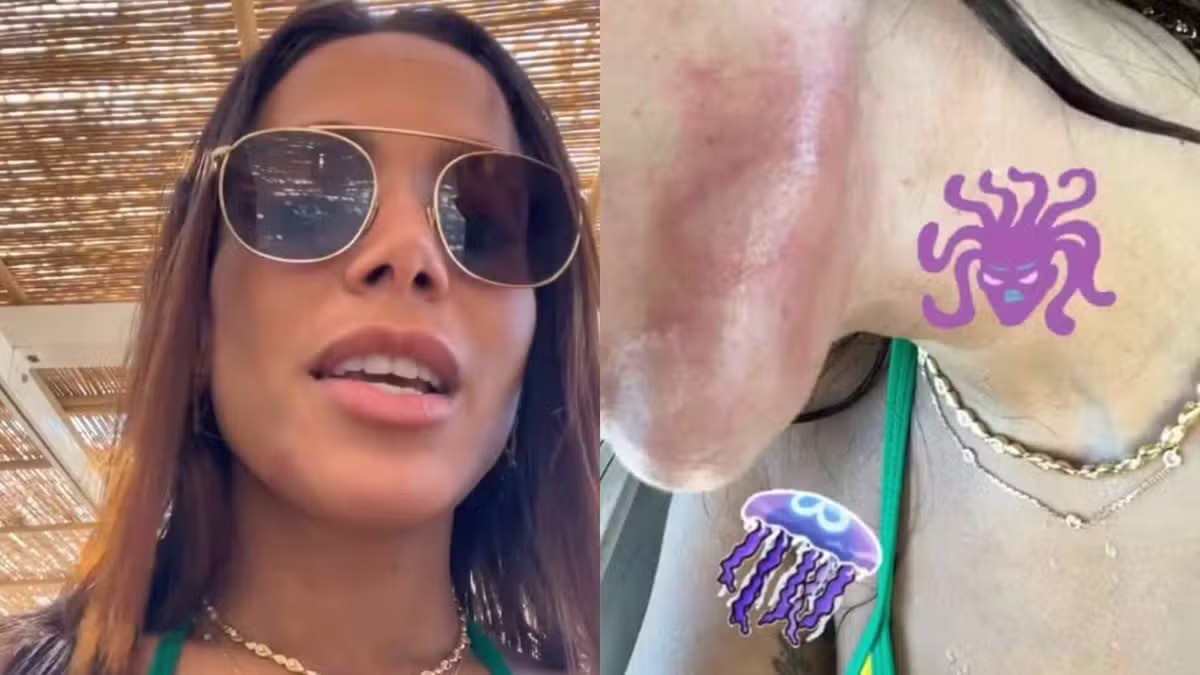 A cantora Anitta divulgou sua queimadura por uma água-viva em Ibiza