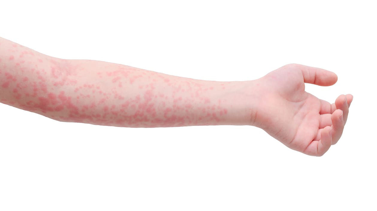 A child's arm with a red rash on it.