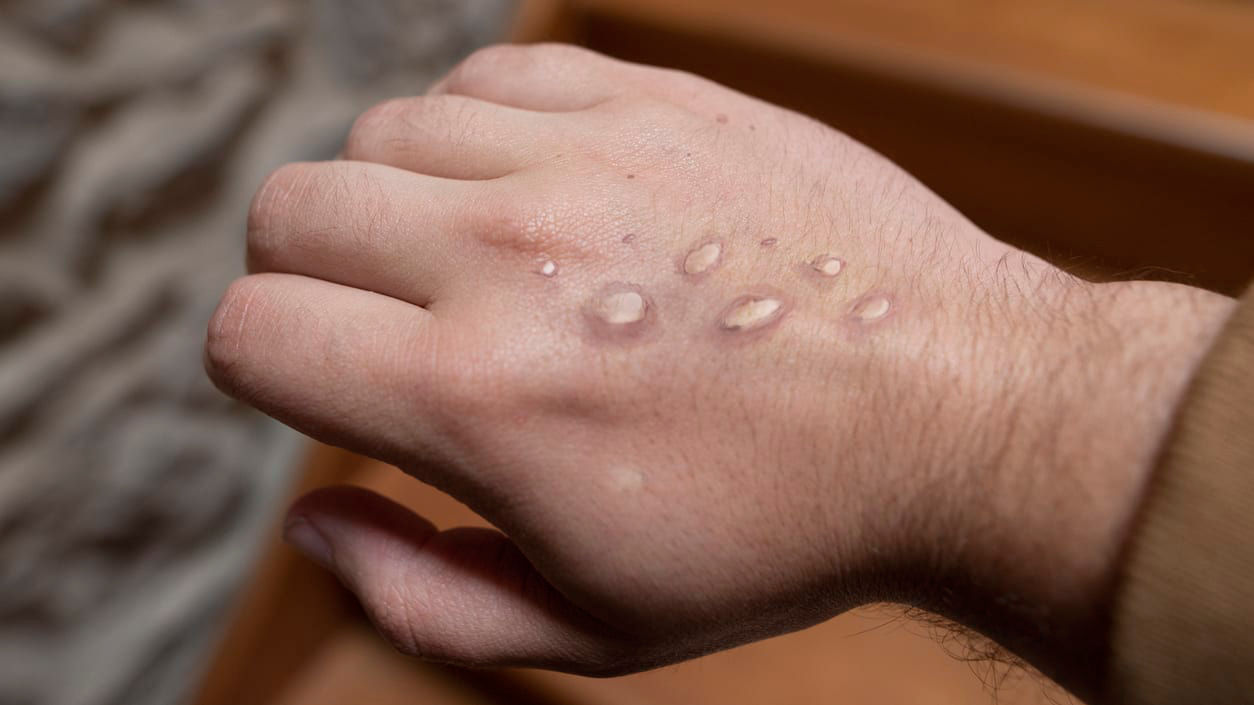 A man's hand with spots on it.