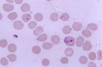 Figure 3 – Plasmodium vivax parasite infection in human blood sample