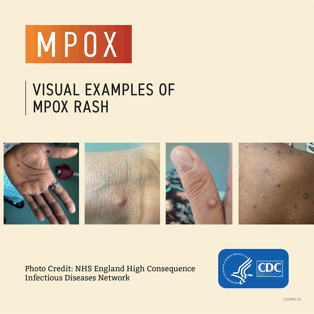 Examples of mpox rash