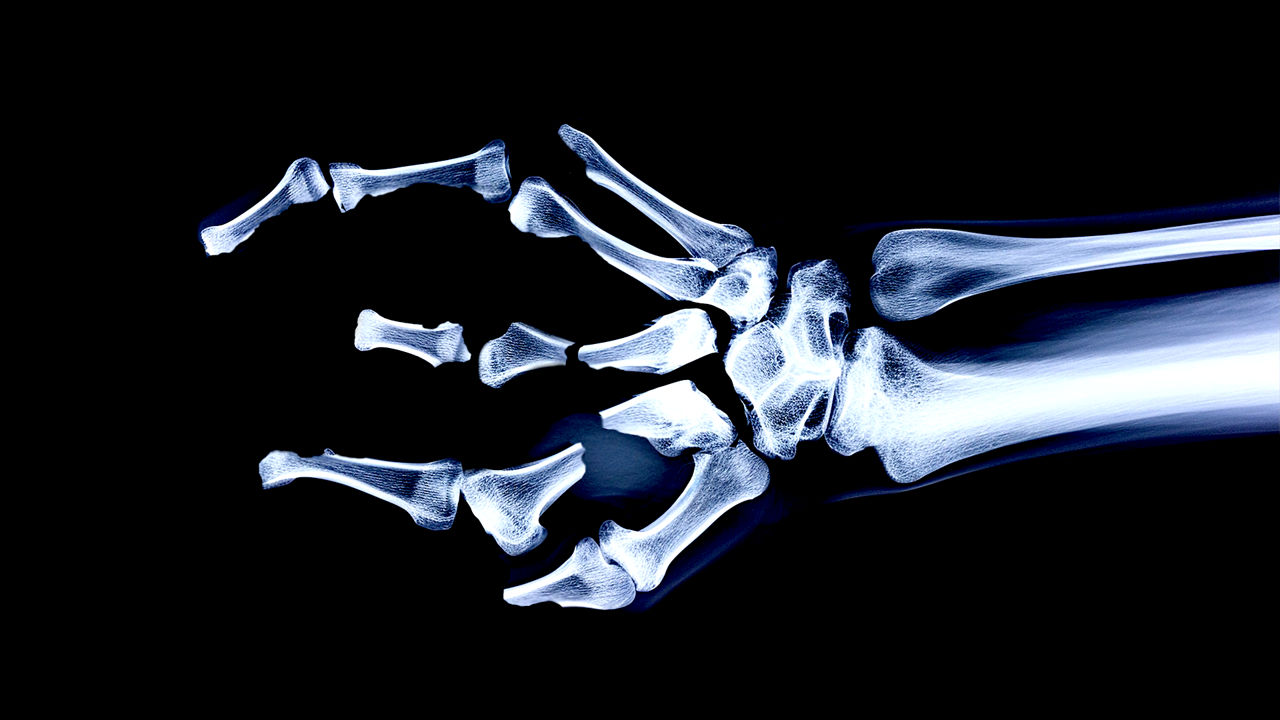 X-Ray shows a hand with missing fingers.