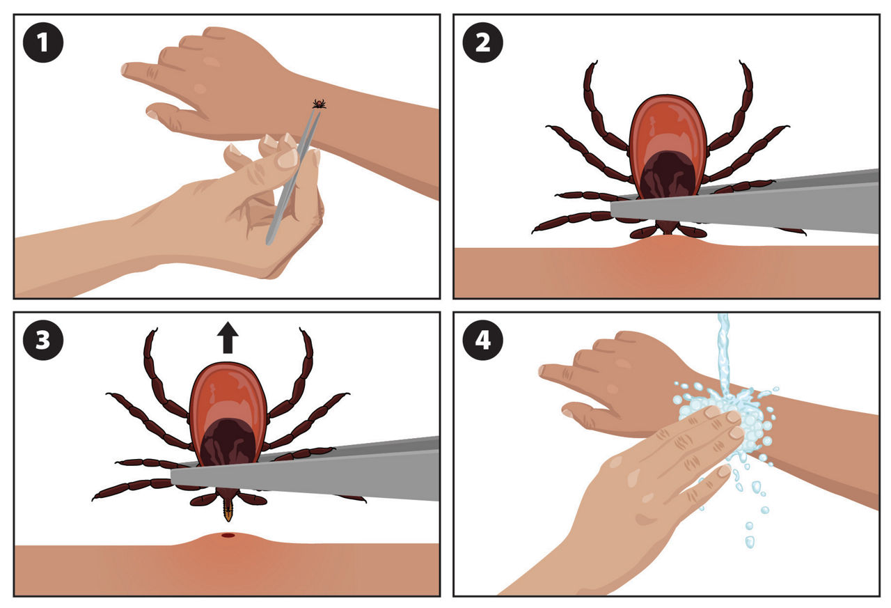 Four-step graphic showing how to remove a tick