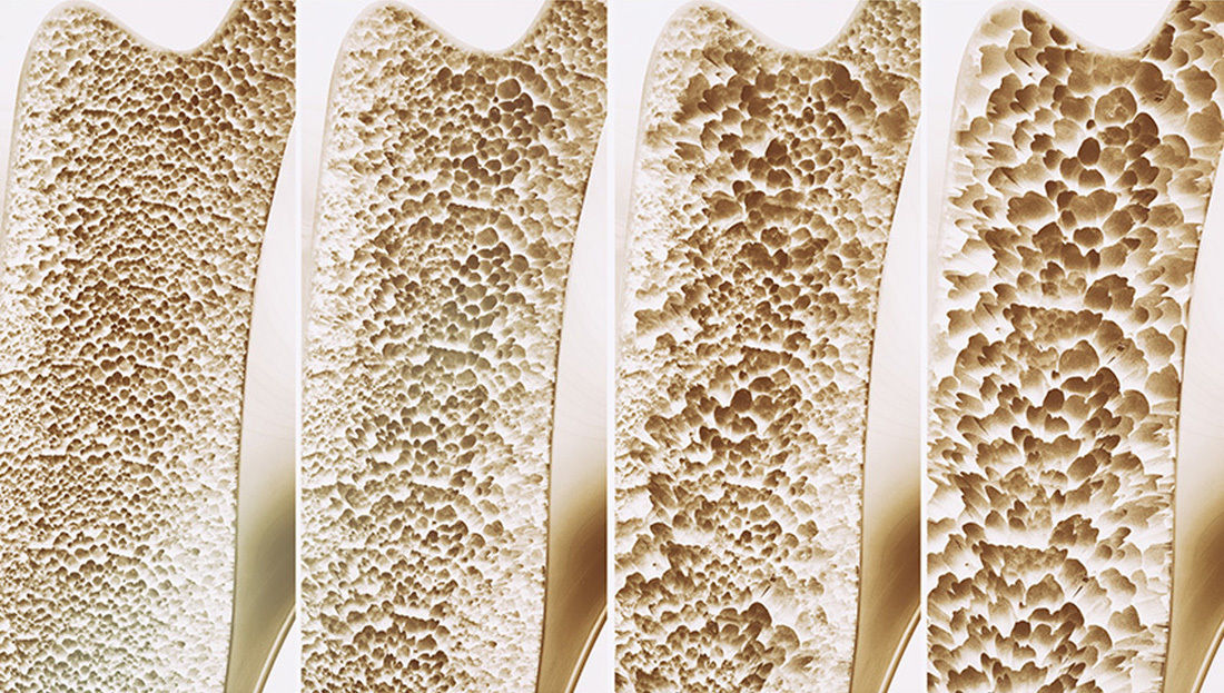 The image displays four cross-sections of bone, each illustrating a different stage of bone density loss. The progression moves from healthy, dense bone structure on the left to increasingly porous and fragile bone on the right. The visual highlights the changes in bone texture and porosity, commonly associated with conditions like osteoporosis. No visible text or numbers are present in the image.