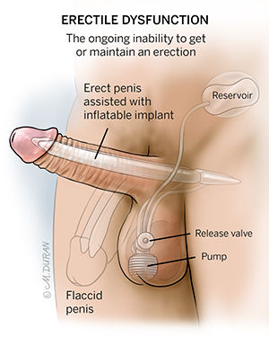 Labeled anatomical diagram shows a cross-section of a penis with an inflatable implant for erectile dysfunction. The image details the internal components, including the reservoir, pump, and release valve, with clear labels. The illustration contrasts an erect penis assisted by the implant and a flaccid penis. The setting is clinical and educational, with a neutral color palette. Visible text includes 'ERECTILE DYSFUNCTION,' 'erect penis,' 'flaccid penis,' 'reservoir,' 'release valve,' and 'pump.'