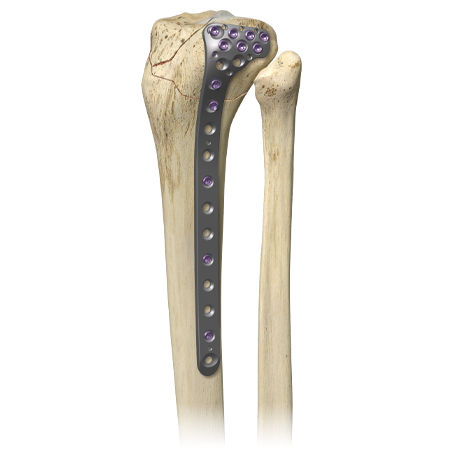A.L.P.S. mvX® Proximal Tibia System from Zimmer Biomet