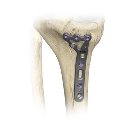 A.L.P.S. mvX® Proximal Tibia System from Zimmer Biomet