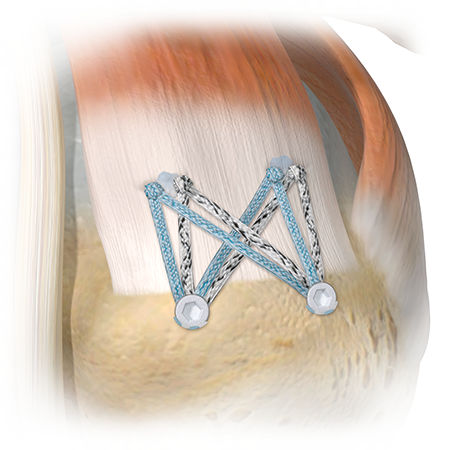 Zimmer Biomet's ActivBridge™ Construct Soft Tissue Repair Augmentation