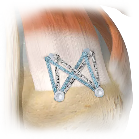 Zimmer Biomet's ActivBridge™ Construct Soft Tissue Repair Augmentation