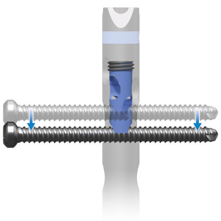 AFFIXUS® Tibia Nailing System from 91�Թ���