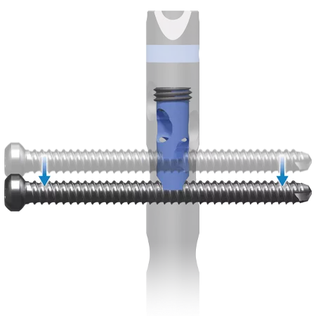 AFFIXUS® Tibia Nailing System from Zimmer Biomet