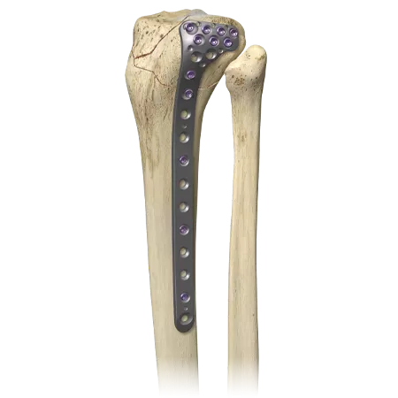 A.L.P.S. mvX® Proximal Tibia System from Zimmer Biomet